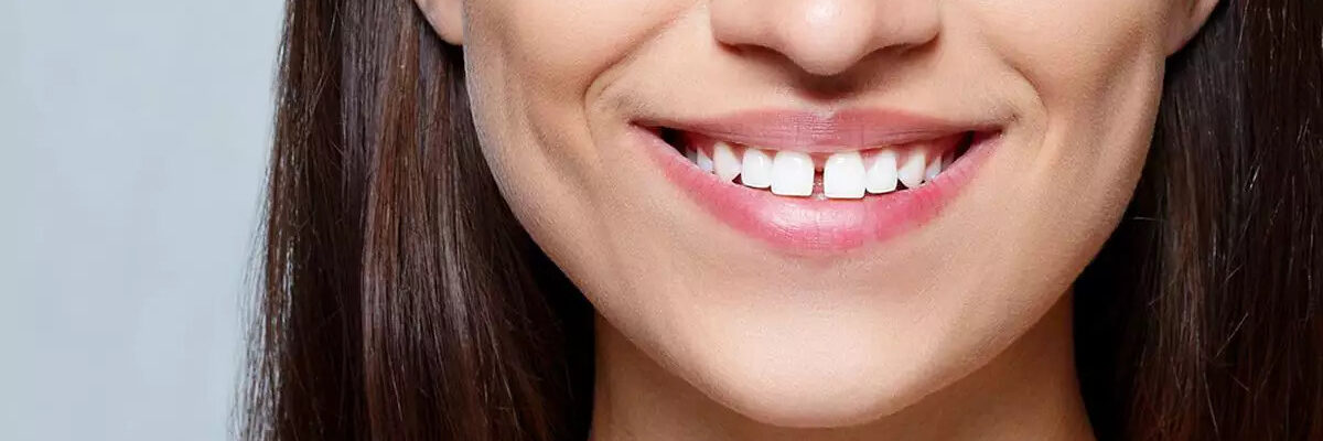 diastema