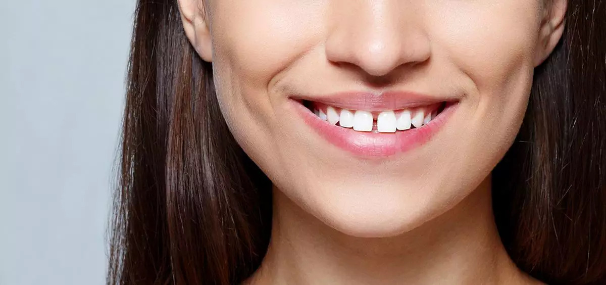 Diastema: Understanding, Causes and Cultural Impact