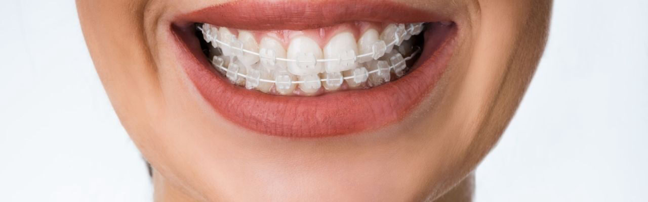 cosmetic braces