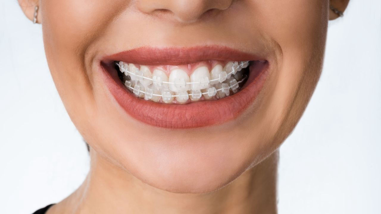 Smiling with Confidence: A Deep Dive into Cosmetic Braces