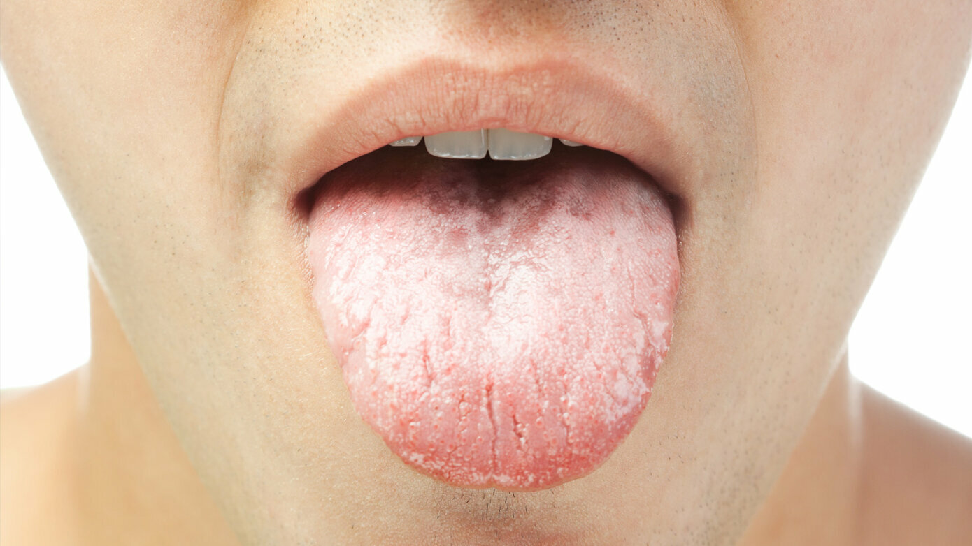 Dry Mouth: Winning the Battle for Improved Oral Health